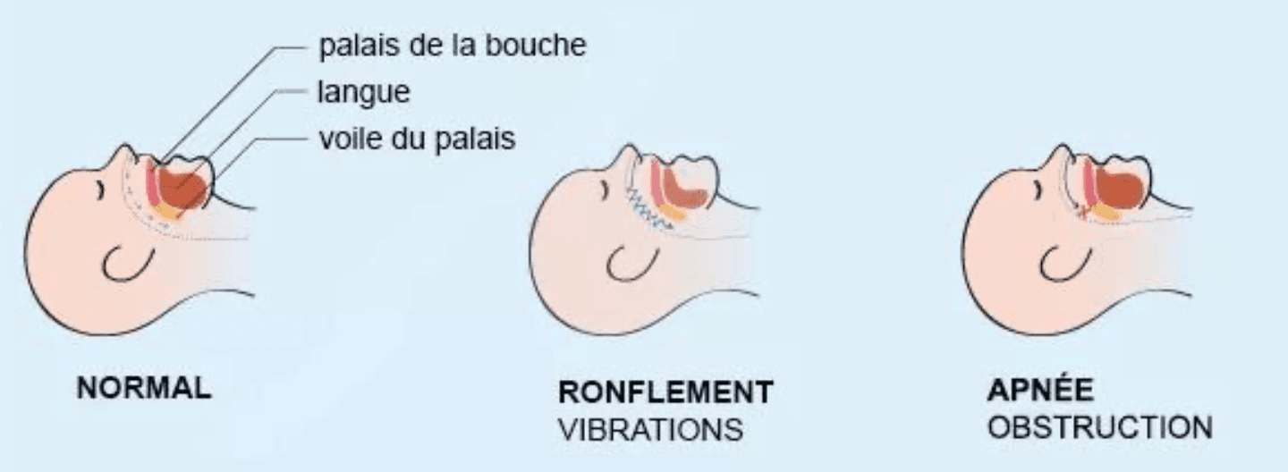 Illustration de l'obstruction des voies aériennes